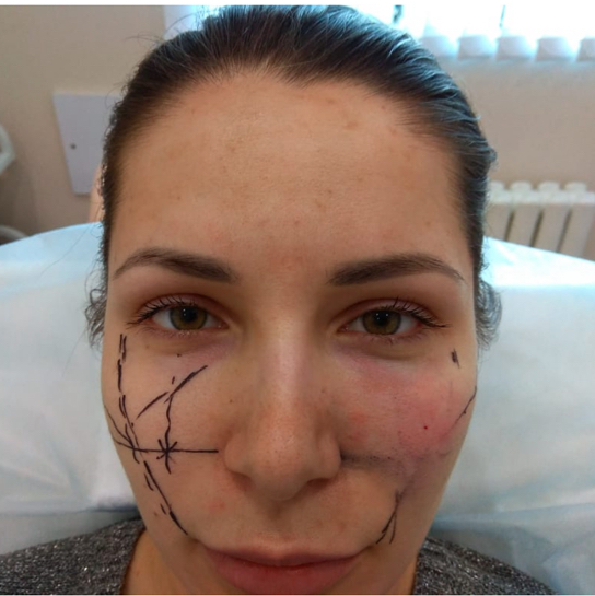 Контурная пластика скул