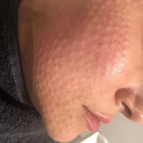 Aquashine биоревитализация