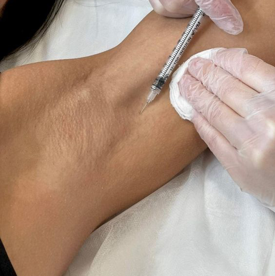 Лечение гипергидроза