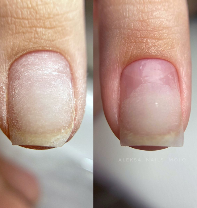 Ремонт ногтя