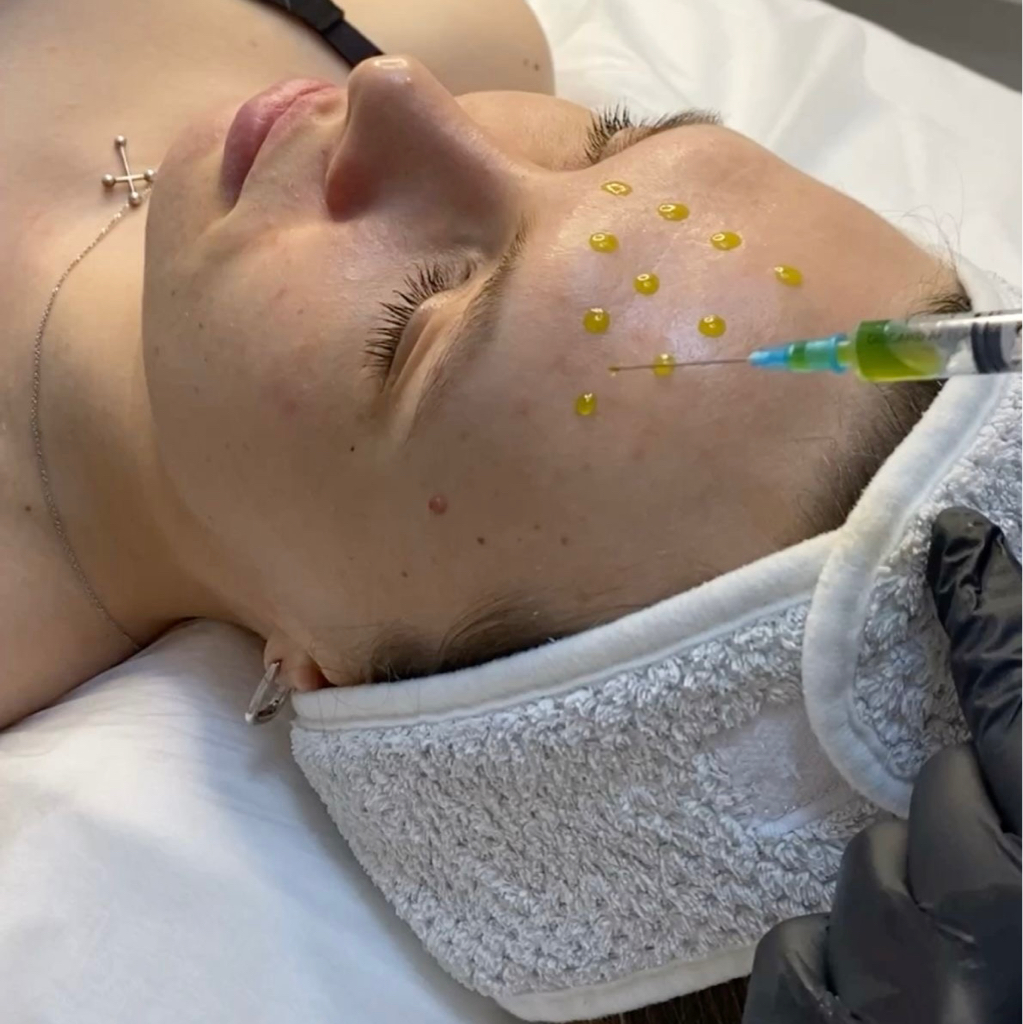 Ретиноловый пилинг, пилинг Джесснера