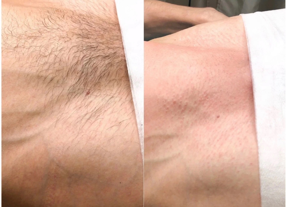 Депиляция тотальное бикини