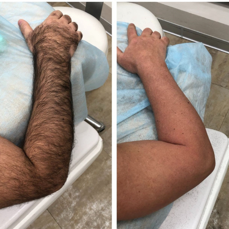 Депиляция руки целиком