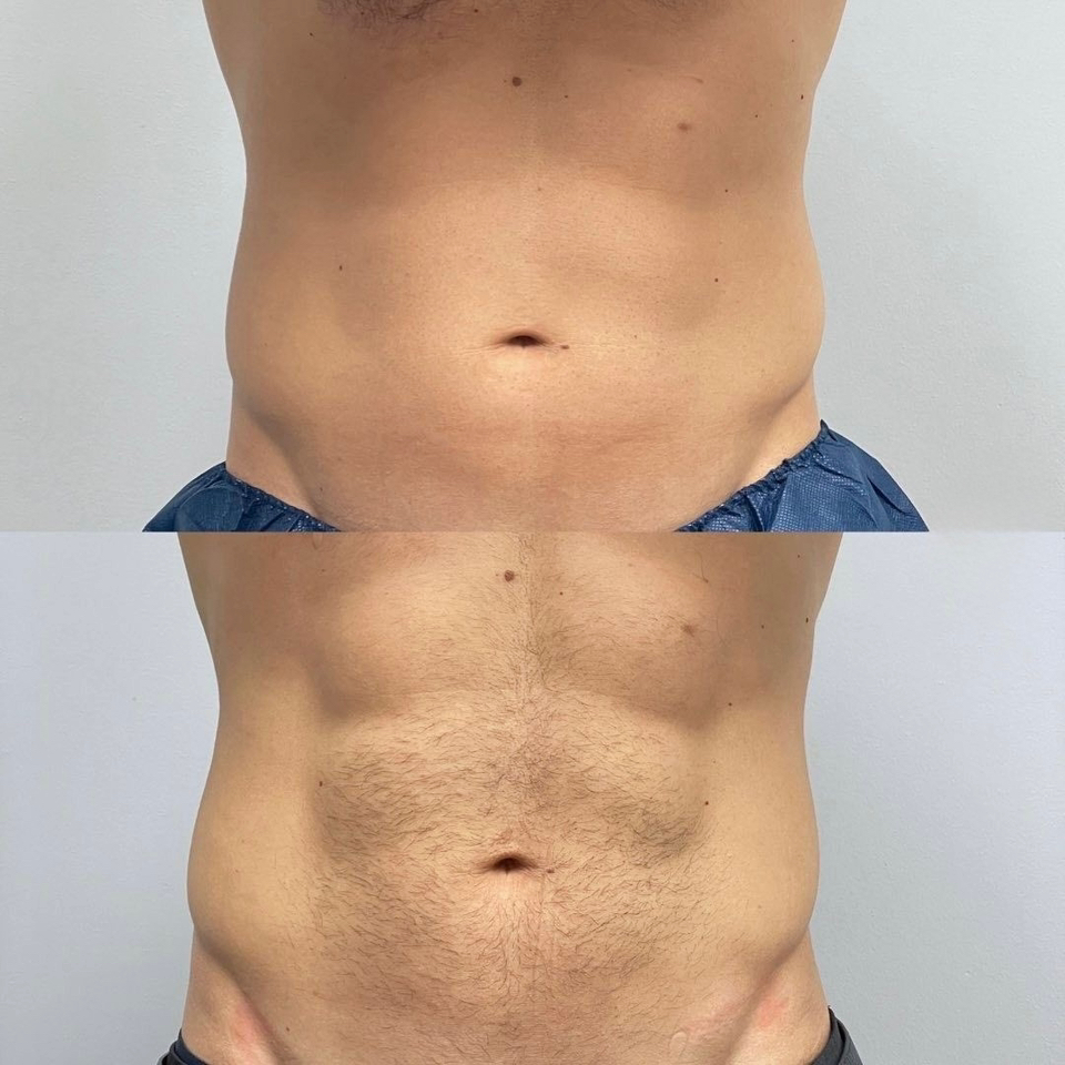 Депиляция грудь или живот