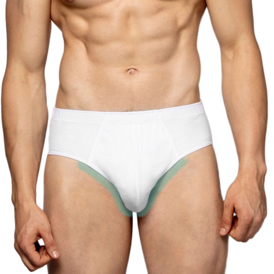 Лазер глубокое бикини