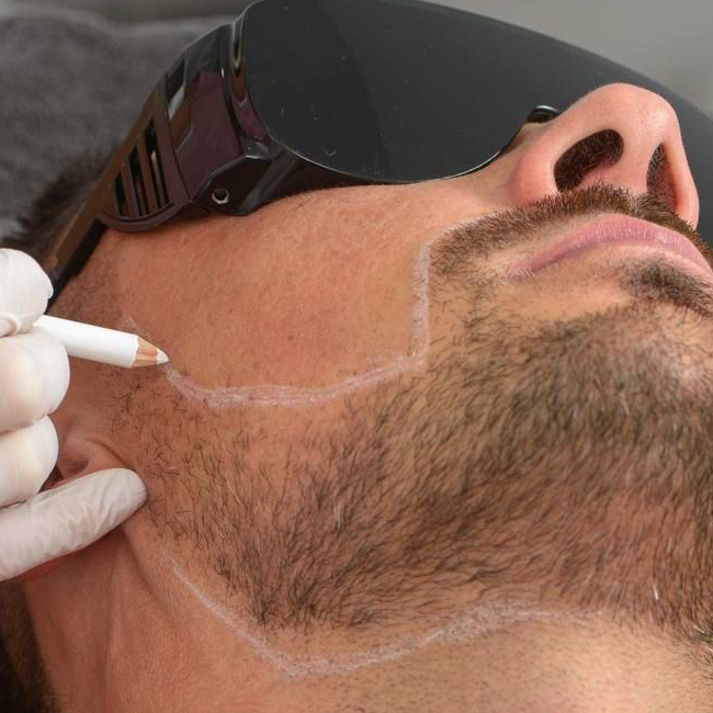 Лазер лицо одна зона