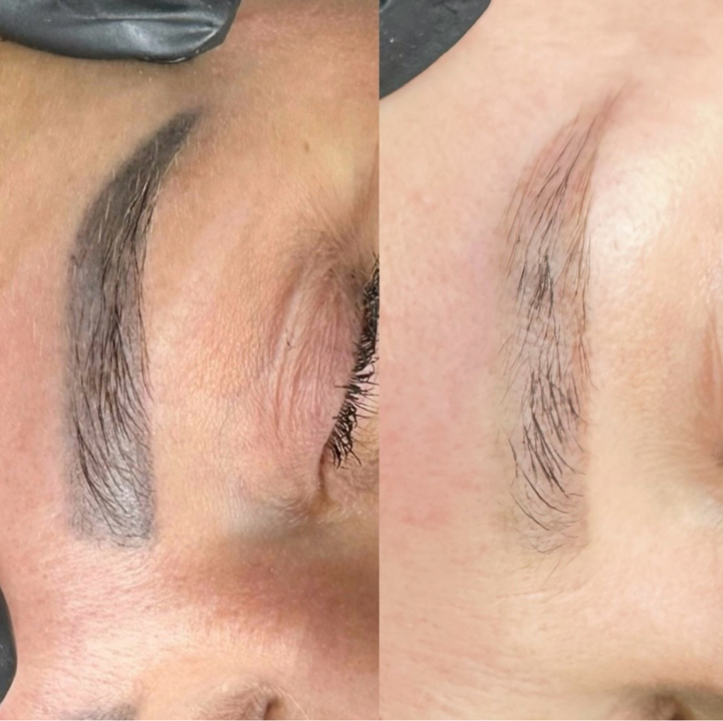 Лазерное удаление татуажа/ татуировки