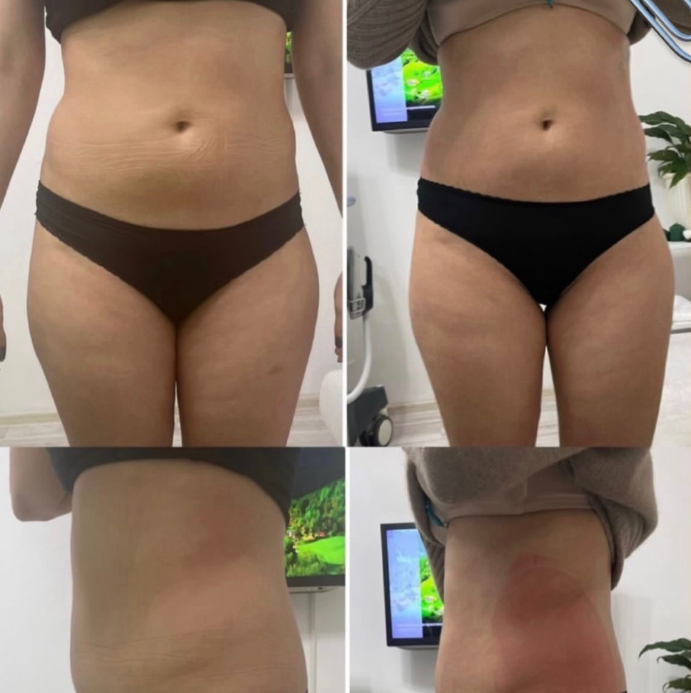 Комплекс 1  Микровейв+ lpg Криолиполиз