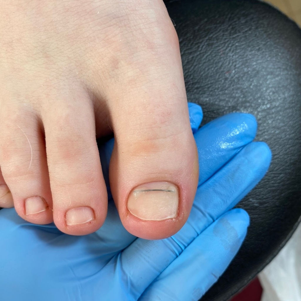 Установка титановой нити