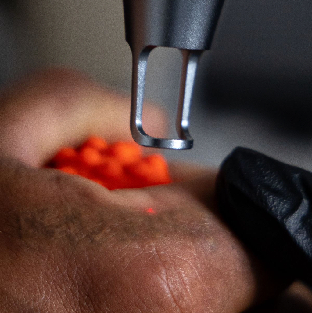 Удаление тату и татуажа лазером