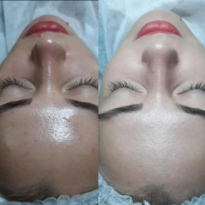 Комплекс по уходу за лицом «Фарфоровая куколка» (фонофорез по сыворотке «Фарфоровая куколка,маска поросуживающая,сыворотка антикуперозная