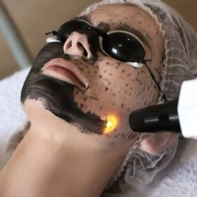 Карбоновый пилинг с маской по типу  кожи в подарок