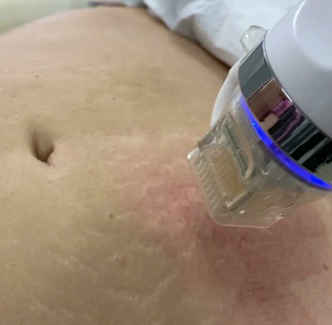 Микроигольчатый RF по телу для похудениях и устранения растяжек  по зонам .1 зона (живот; ягодицы;бёдра)позолоченные микроиглы (одноразовые насадки)