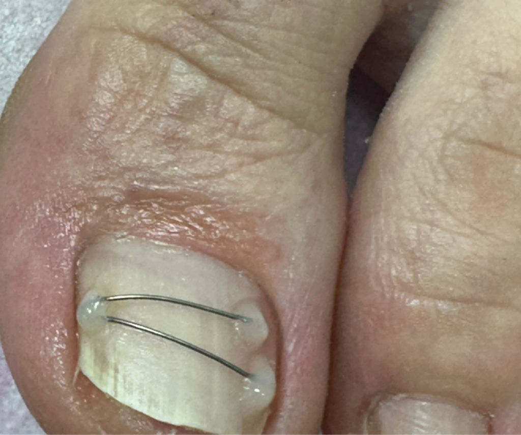 Установка/переустановка титановой нити (1 ноготь)