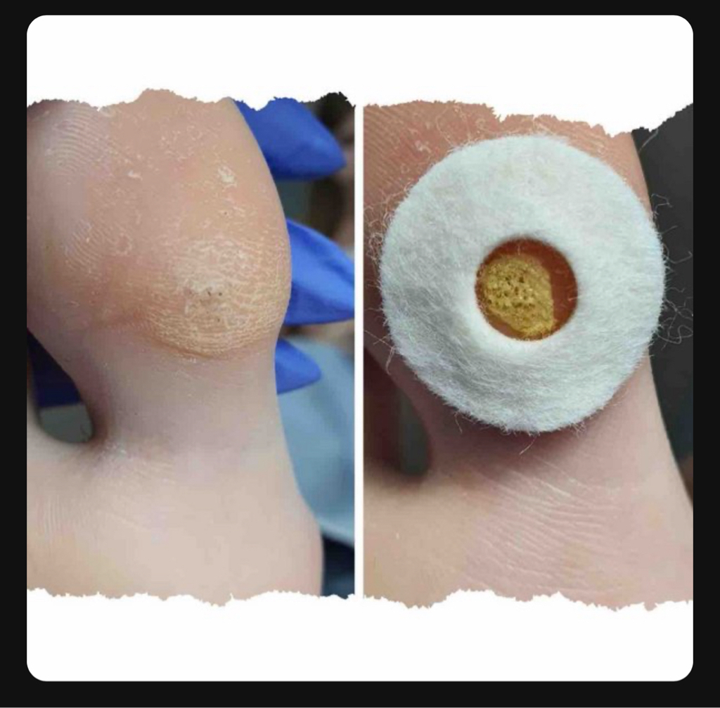 Обработка щипицы