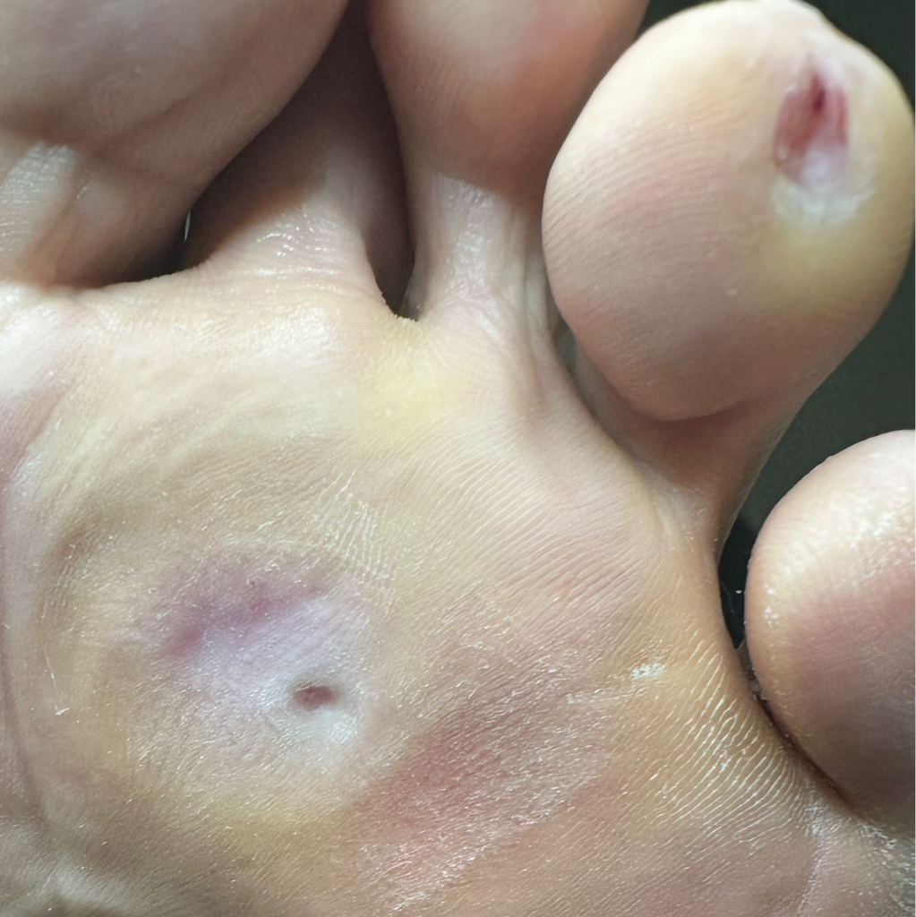 Обработка натоптышей/стержневых мозолей (1 единица)