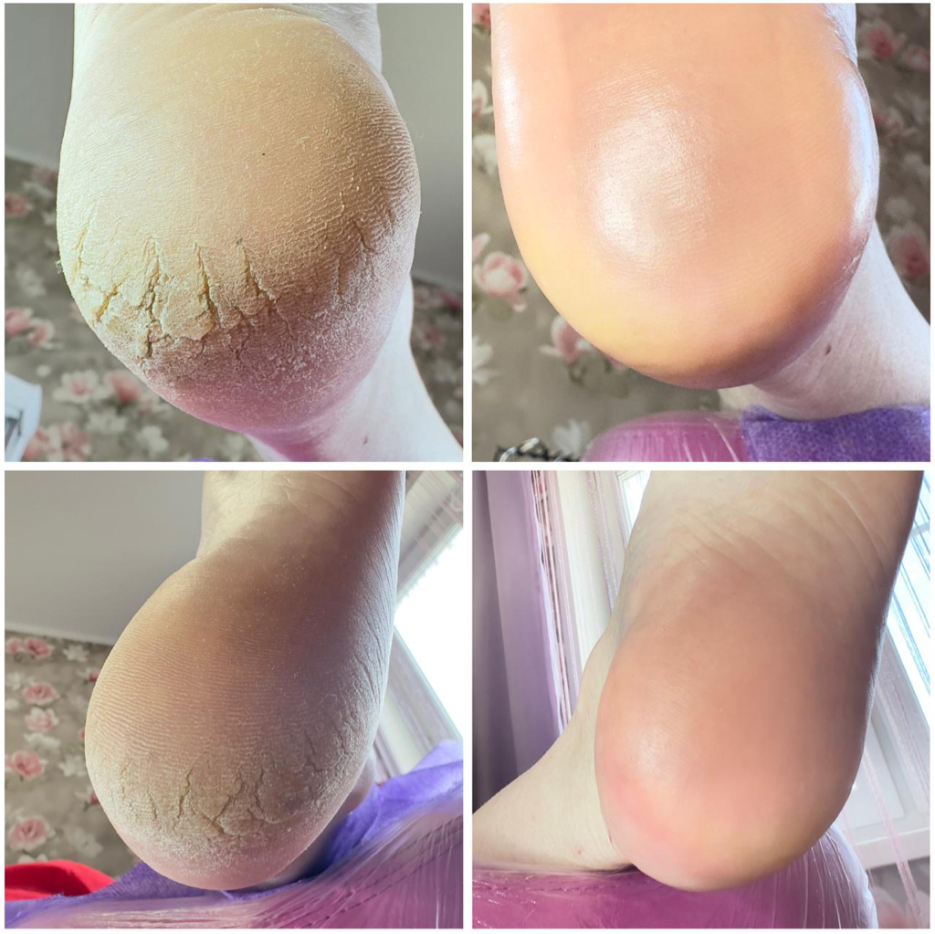 Обработка трещин без разгрузки