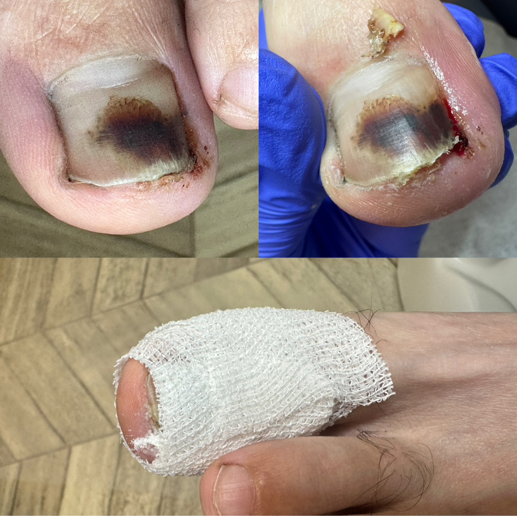 Коррекция врастающей части ногтя