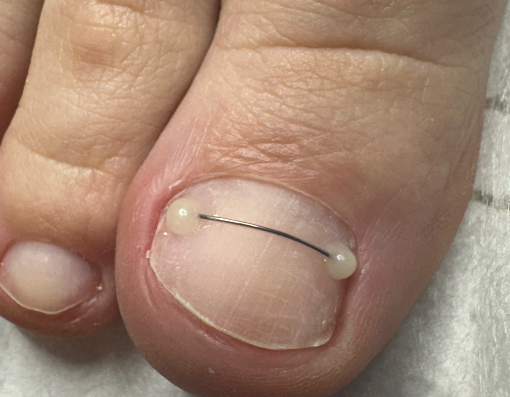 Установка/переустановка титановой нити (2 больших пальца)