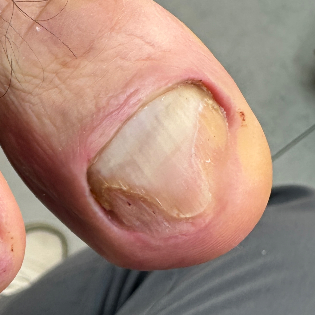 Зачистка утолщенного ногтя (онихолизис, грибковое поражен е ногтей, грифозные ногти)