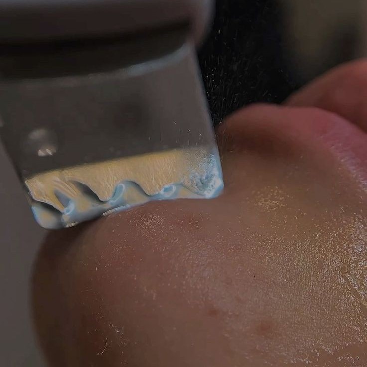 Ультразвуковая чистка лица