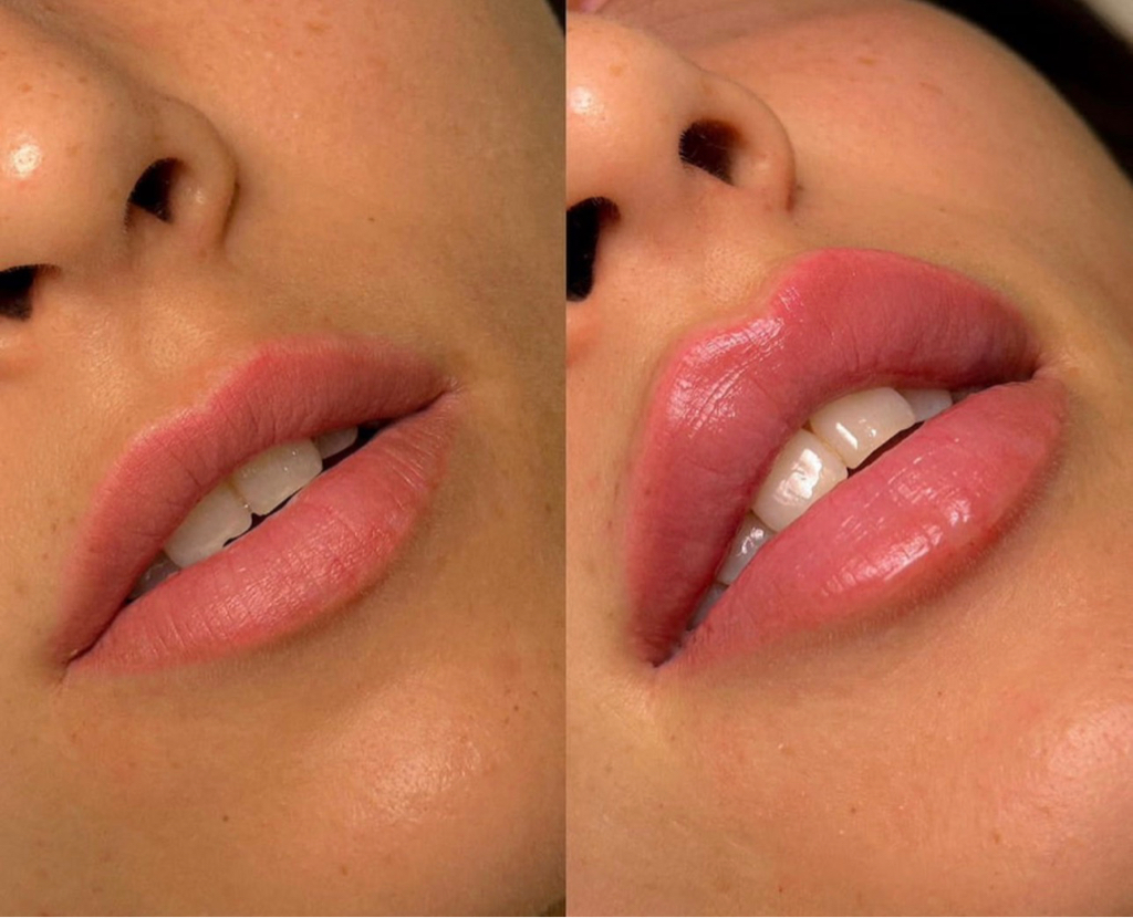 Увеличение губ