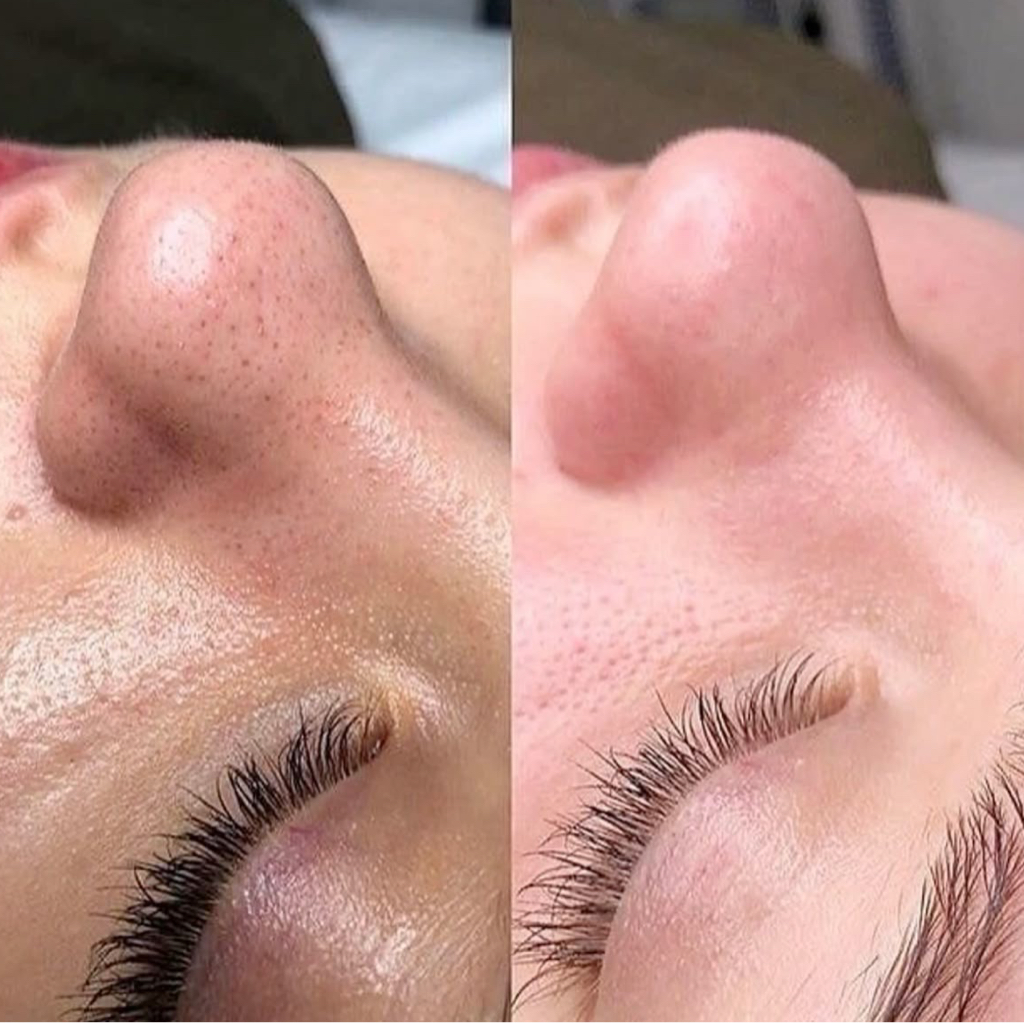 механическая чистка лица