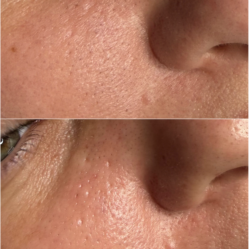 Гидро-пилинг (очищение, гидрирование, гидро пилинг, маска по типу кожи)