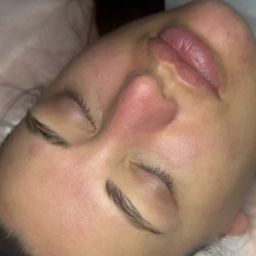 (ультразвуковая чистка, молочный пилинг, RF-лифтинг, крем)