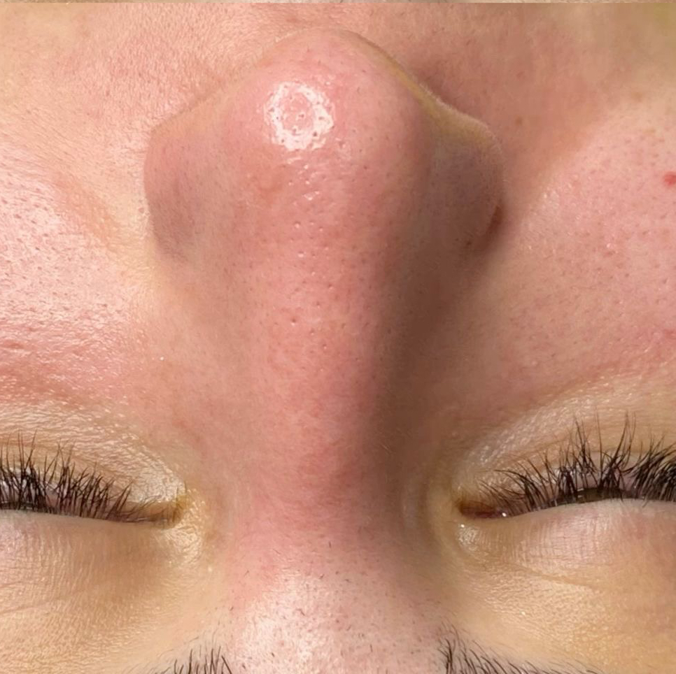 ультразвуковая чистка лица