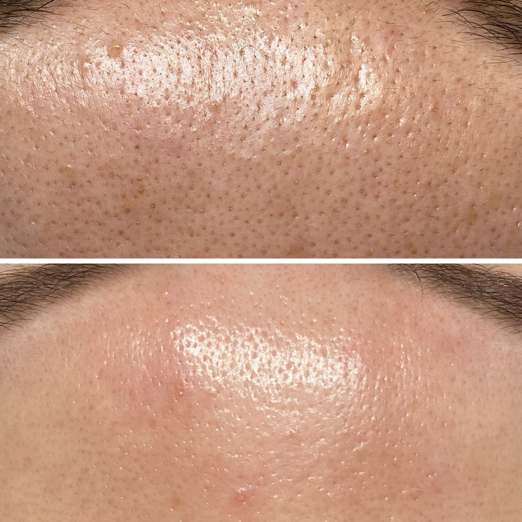 комбинированная чистка лица