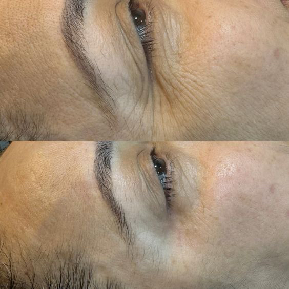 RF-лифтинг  (очищение, гидрирование, rf лифтинг, криоохлаждение, маска по типу кожи)