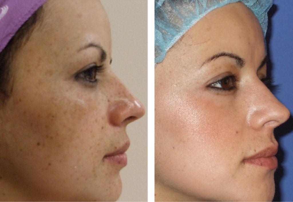 Химический пилинг