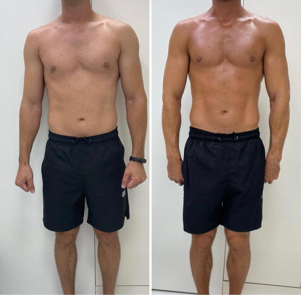 Мужчины: Аппаратная коррекция