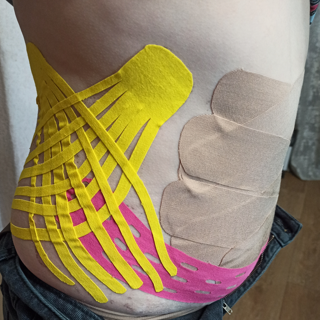 Тейпирование бока