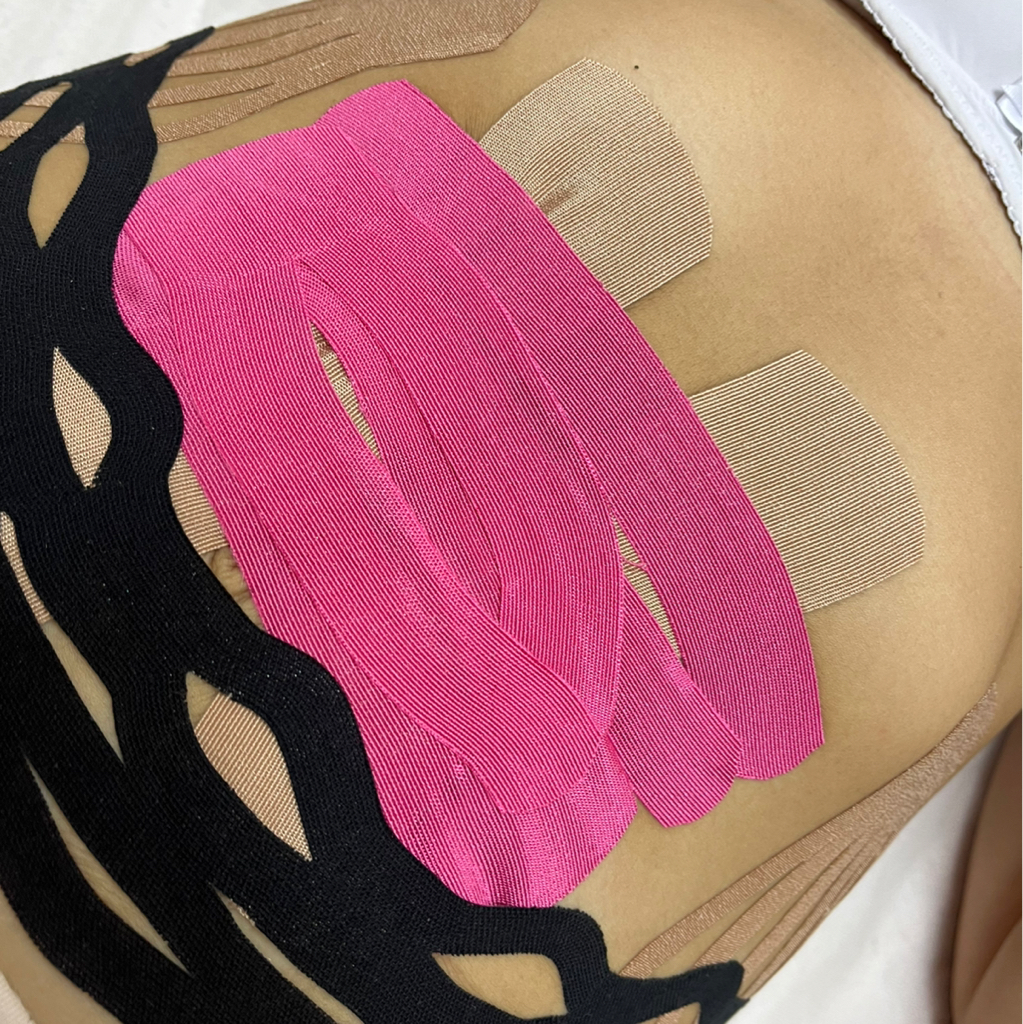 Тейпирование диастаза