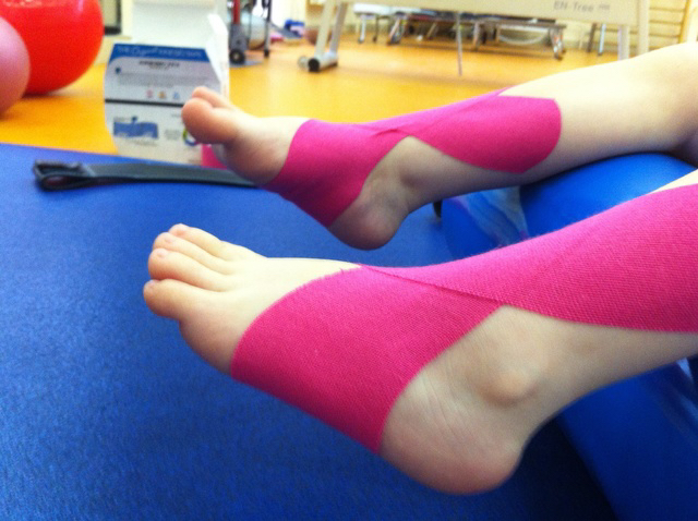 Вальгусная деформация стопы тейпирование