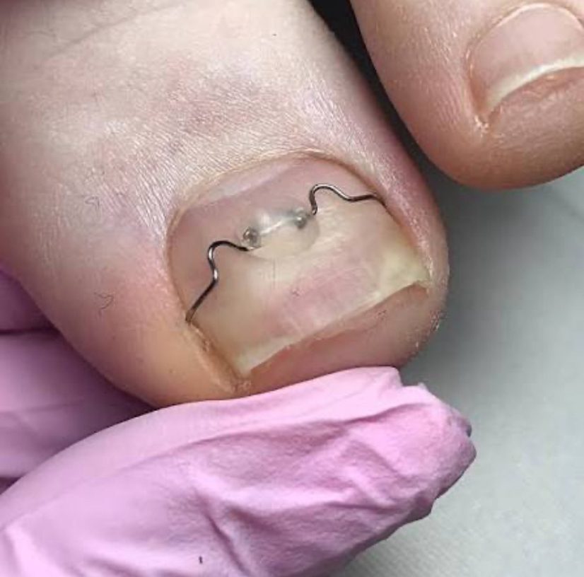 Корректирующая скоба 3ТО