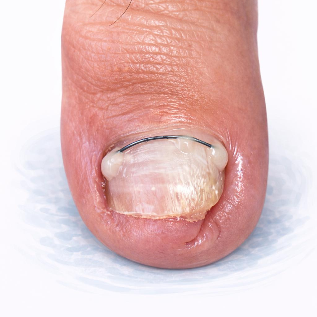 Установка титановой нити