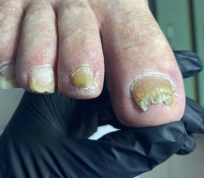 Зачистка онихогрифоза, онихолиза, онихомикоза (1 единица)