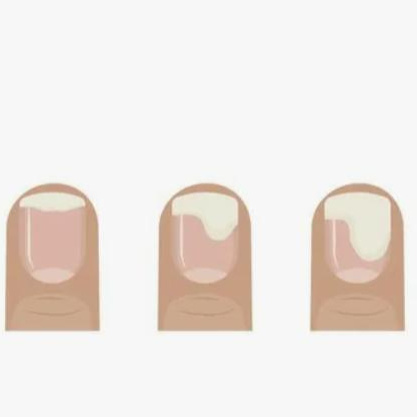 Обработка одного измененного ногтя на ноге или руке