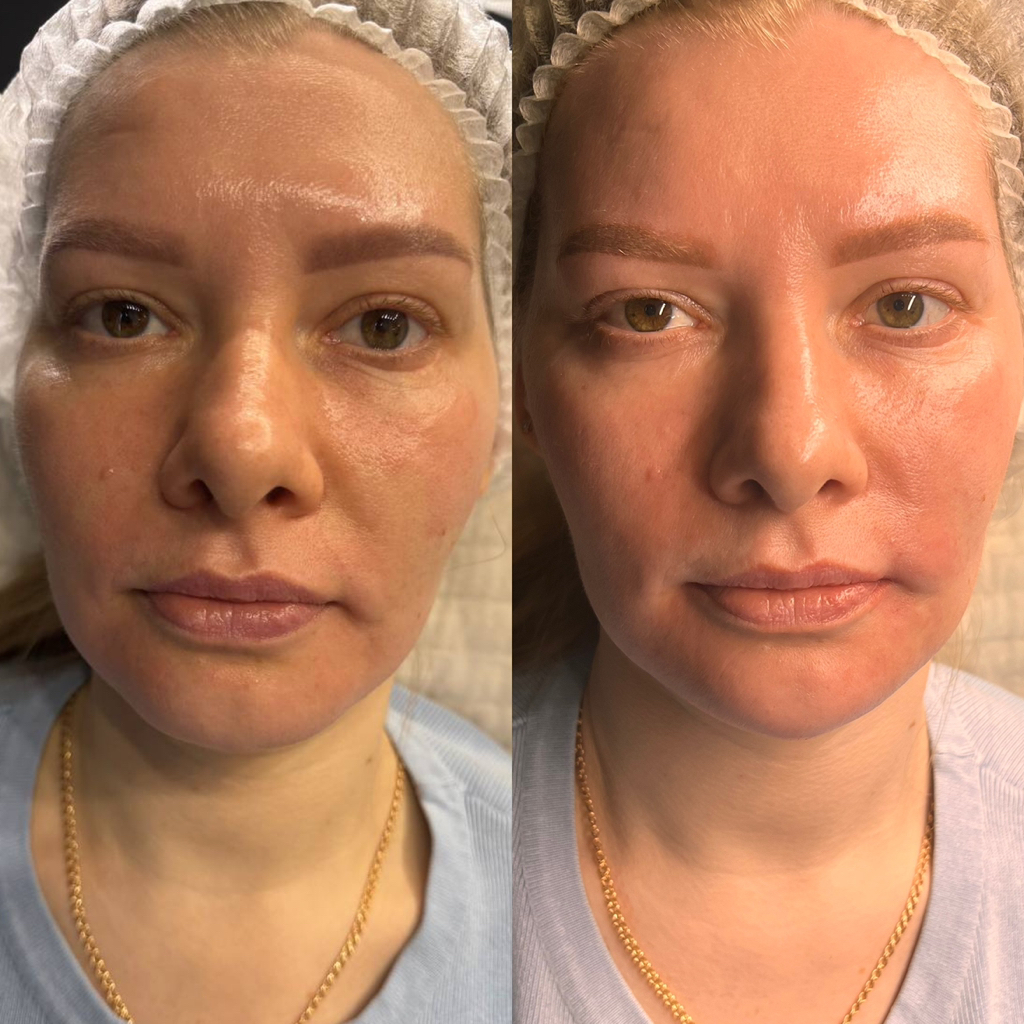 Ровны контуры нижней челюсти без брылей