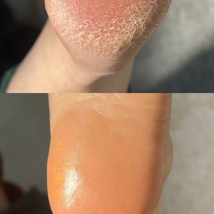 Обработка пяток ( обработка пяток в аппаратной технике, пилинг и нанесение крема).