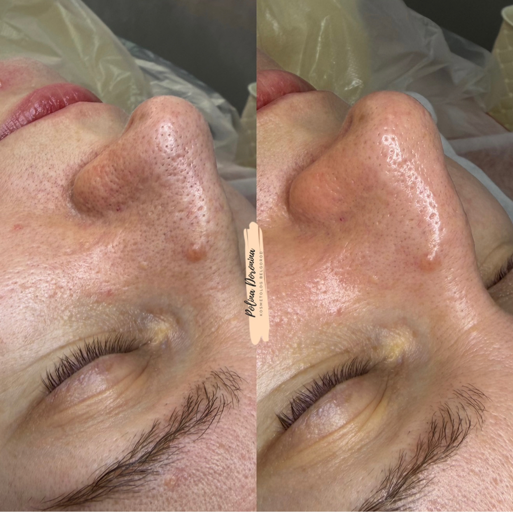 АКЦИЯ ФЕВРАЛЯ! Дермабразия + «СИЯЙ, как звезда»