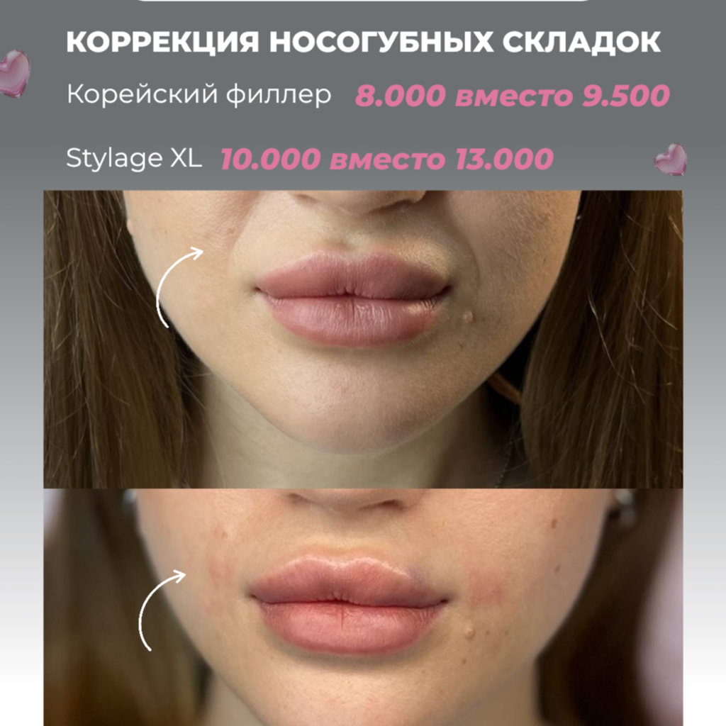 КД❤️ контурная пластика носогубных складок 8000 вместо 9500