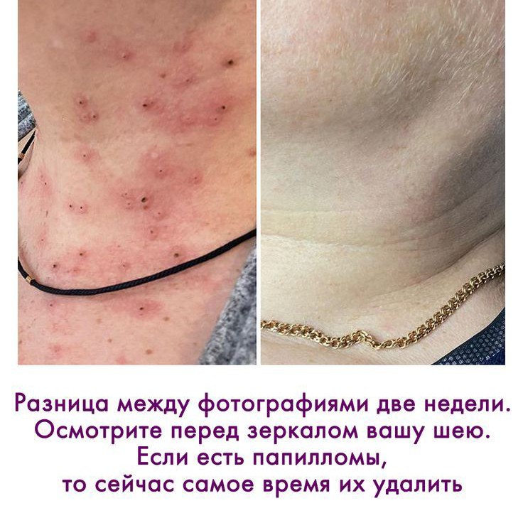 Удаление папиллом
Много мелких? Считаем не за штуку, а за зону.