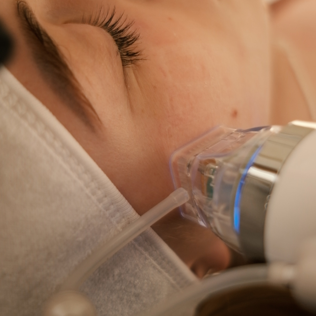 Сет "Красота Афродиты" (Салициловый пилинг + микроигольчатый RF)