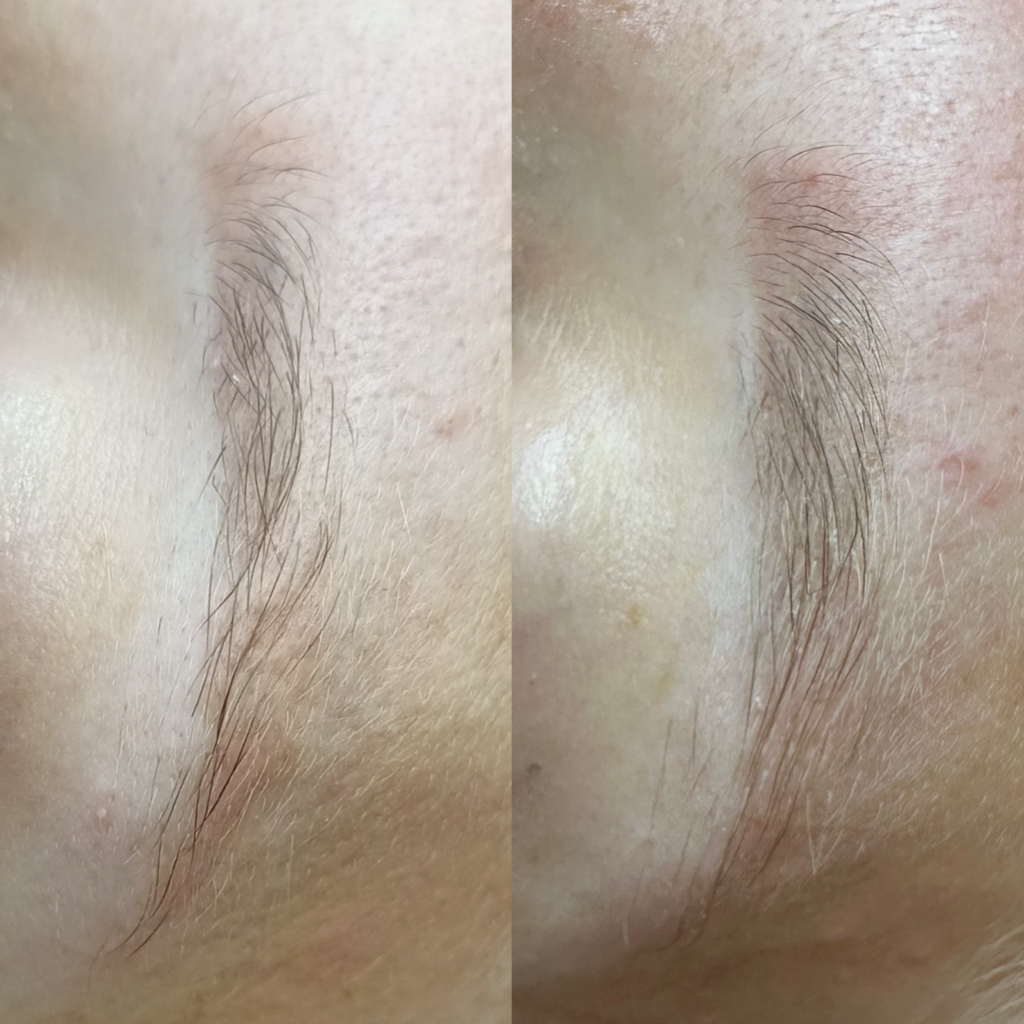 Аппаратное восстановление бровей