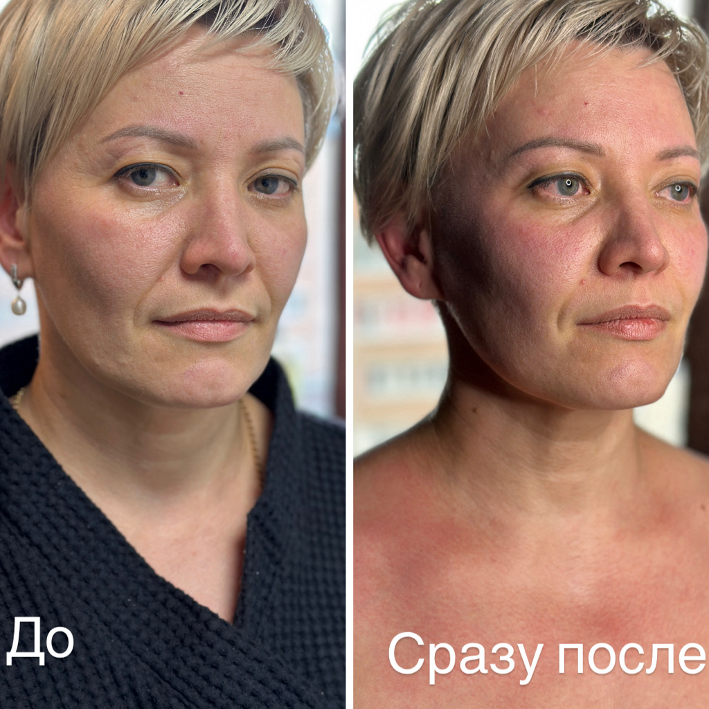 Блефаромассаж - Открытый взгляд