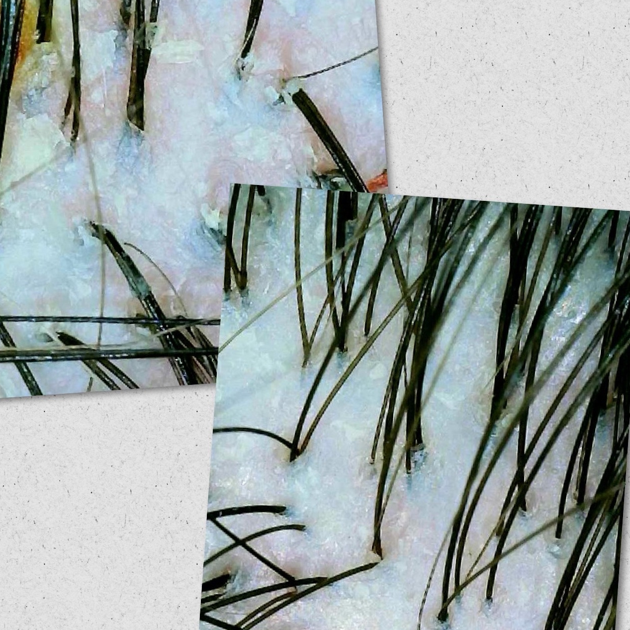 Пилинг кожи головы (дополнение к уходу)